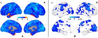 Altered Brain Signal Variability in Patients With Generalized Anxiety Disorder